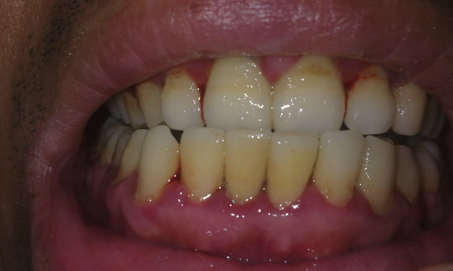 四、烤瓷牙套脱落的其他修复方案